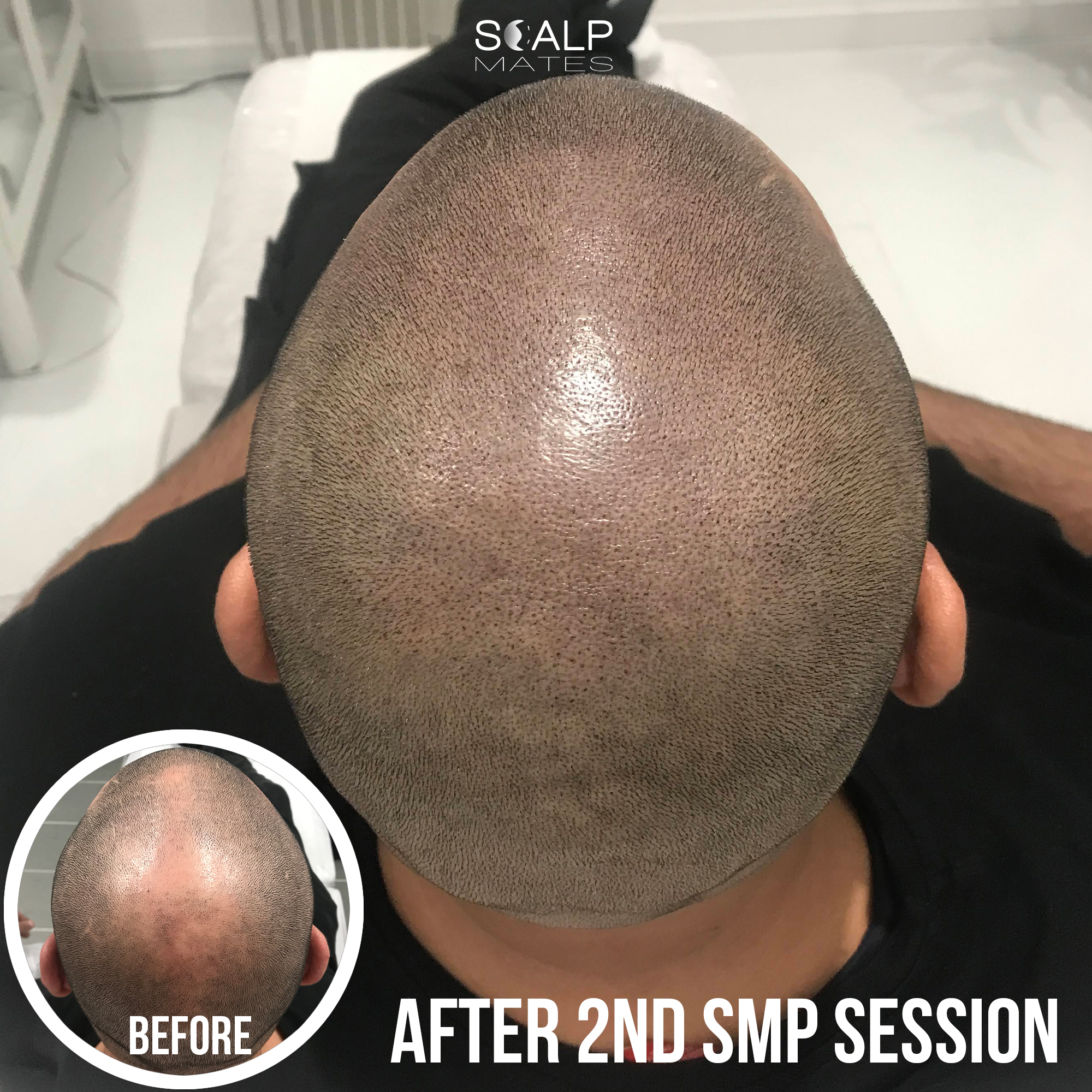 balding crown solution, hair tattoo, scalp micropigmentation course UK