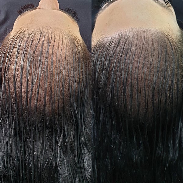 Before and after photo of a female client's hair thinning treatment using Scalp Micropigmentation (SMP) for pattern baldness