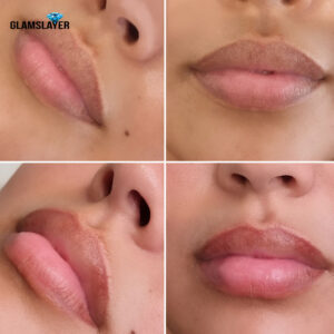 Two images depicting the transformative results of a lip neutralization procedure.