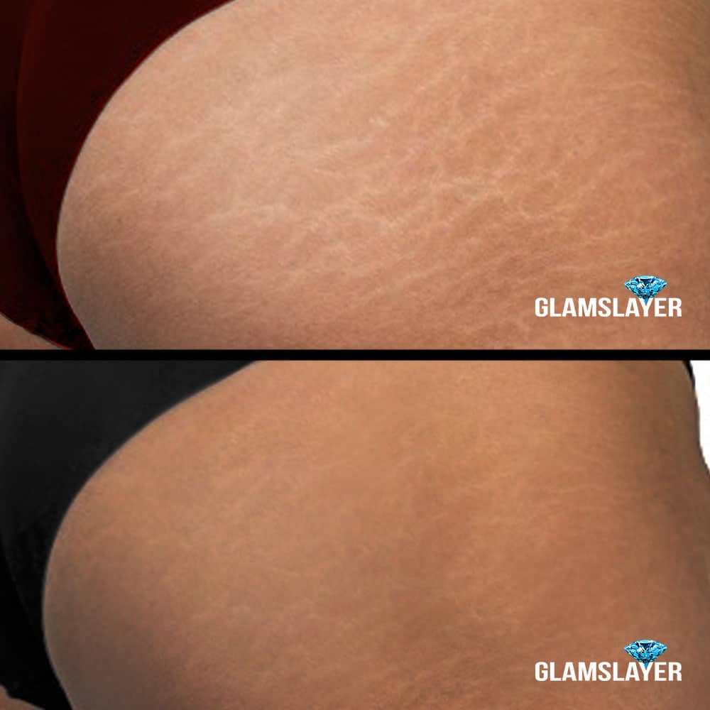 Before and after results of MCA Microneedling for stretch marks on buttocks after pregnancy or workout by Glamslayer.